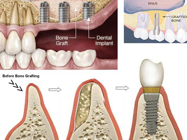 ایمپلنت دندان برای بیماران با پوکی استخوان