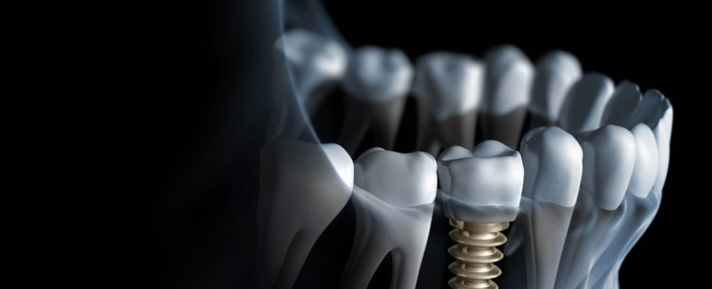 عوارض ایمپلنت دندان شامل چه مواردی می شود؟