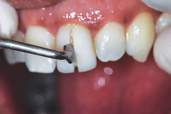 معایب و عوارض لمینت دندان
