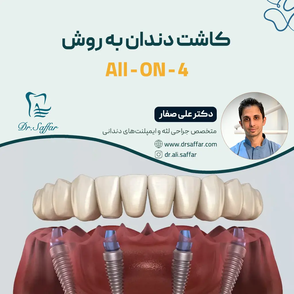 کاشت دندان به روش all on ۴