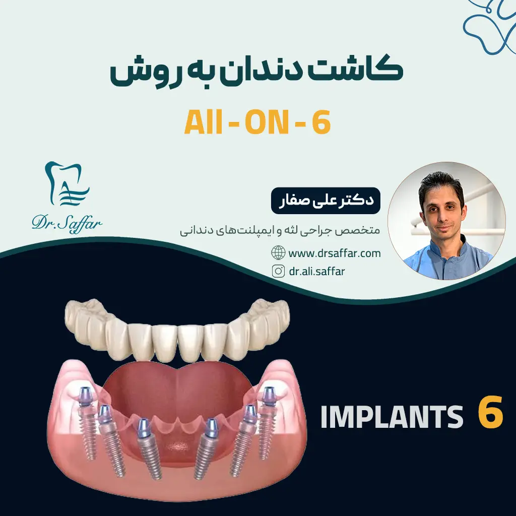 کاشت دندان به روش all on 6