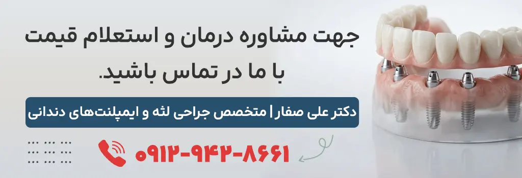 مشاوره و استعلام هزینه ایمپلنت all on 6