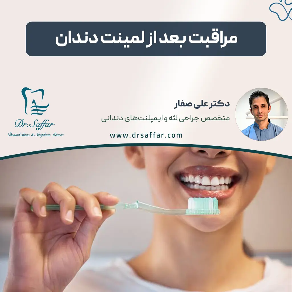 مراقبت بعد از لمینت