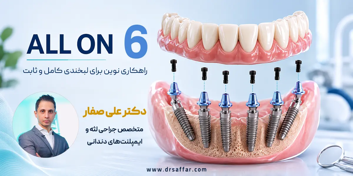 ایمپلنت به روش all on 6 با دکتر علی صفار