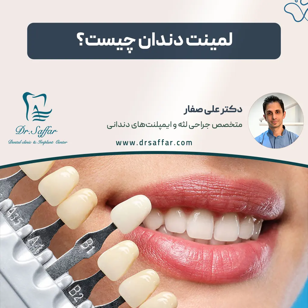 لمینت دندان