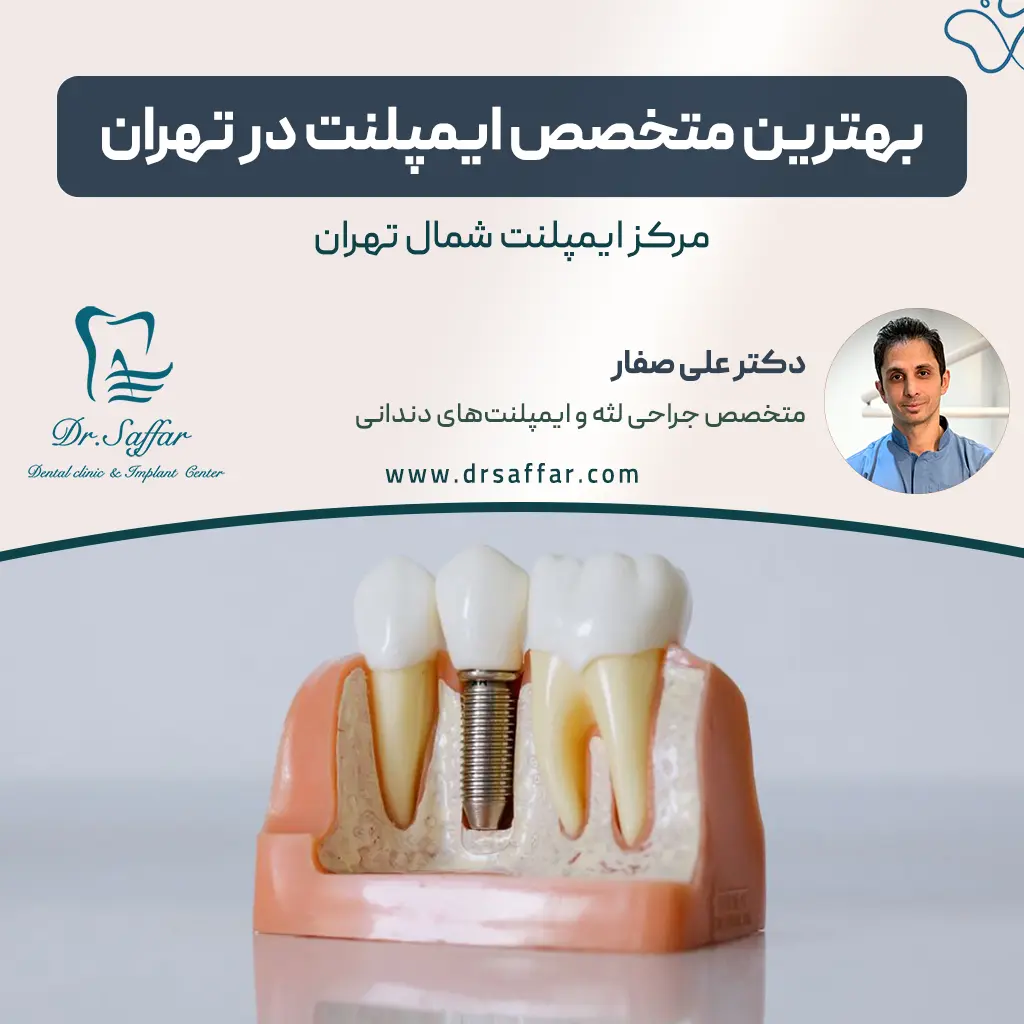 بهترین متخصص ایمپلنت در تهران