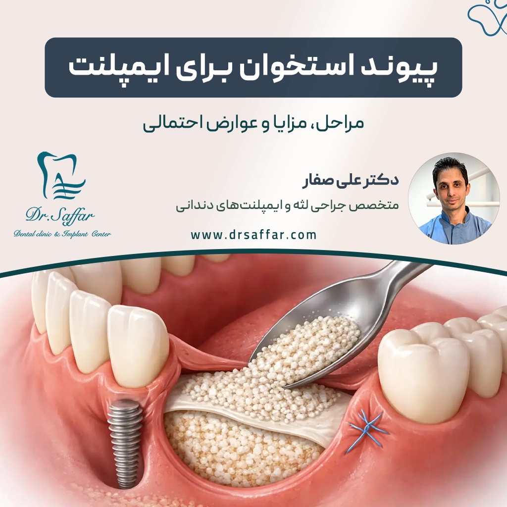 پیوند استخوان برای ایمپلنت دندان