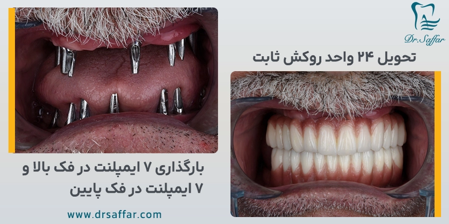 بارگذاری 14 ایمپلنت برای بیمار 75 ساله از کرج