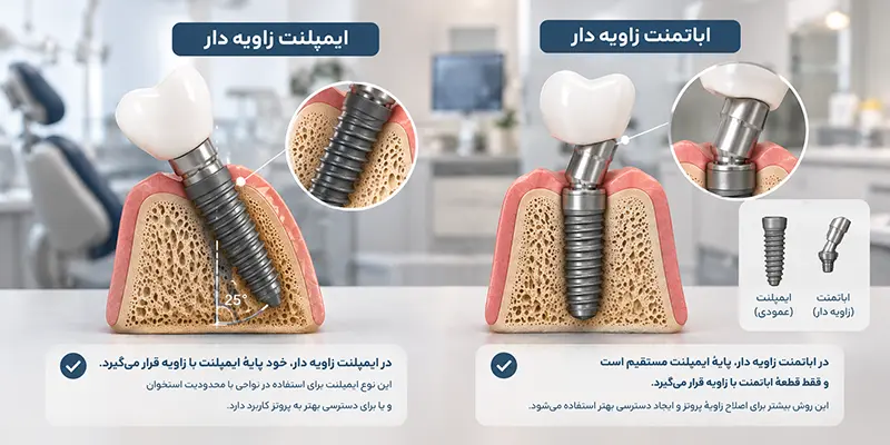 تفاوت ایمپلنت زاویه دار و اباتمنت زاویه دار