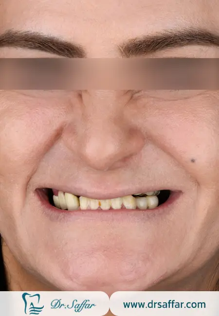 بیمار 45 ساله با تحلیل شدید استخوان فک