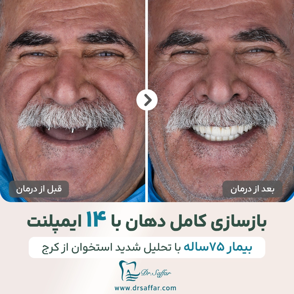 یازسازی کامل دهان با 14 ایمپلنت برای بیمار 75 ساله از کرج