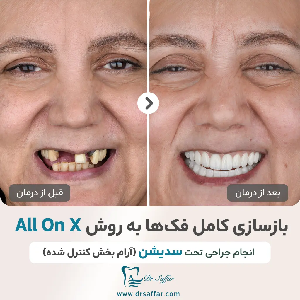 بازسازی کامل دهان با ایمپلنت به روش All-on-X تحت سدیشن