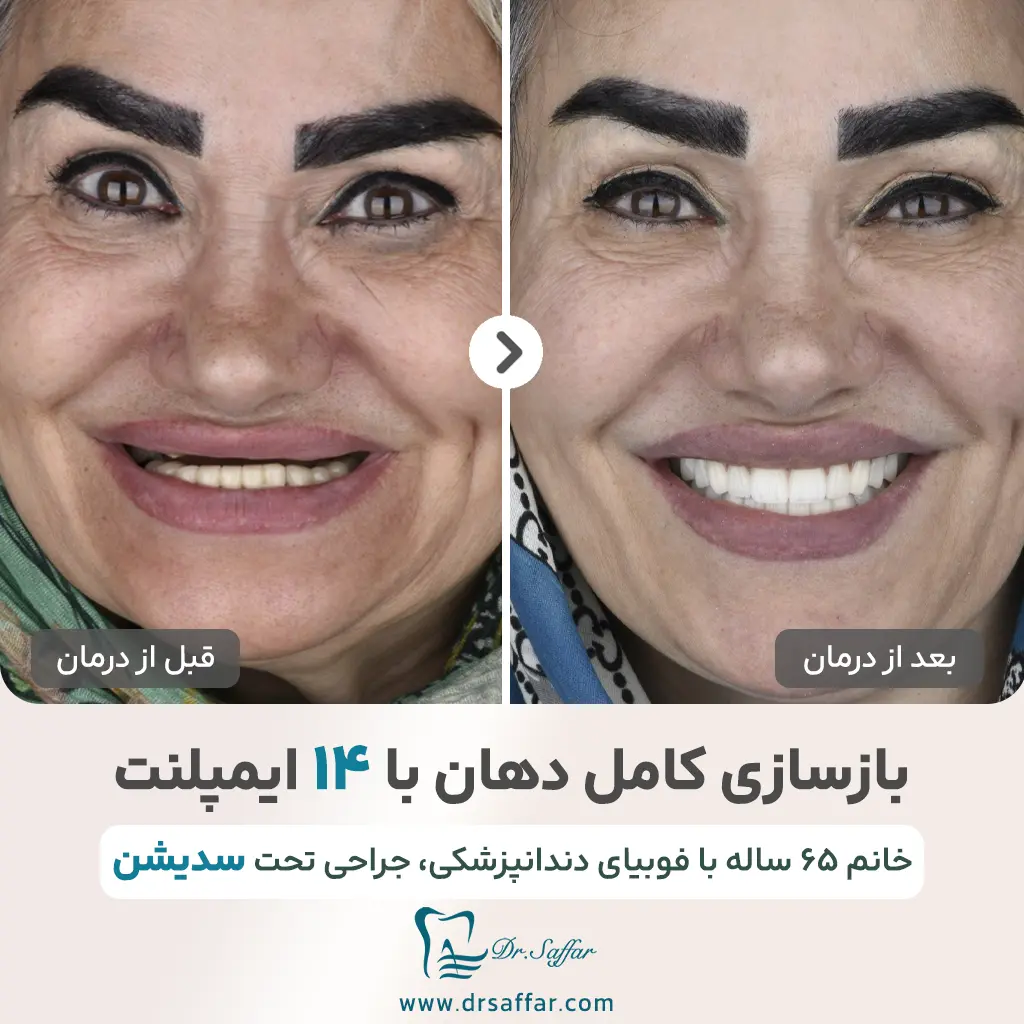 بازسازی کامل دهان با ۱۴ ایمپلنت تحت سدیشن