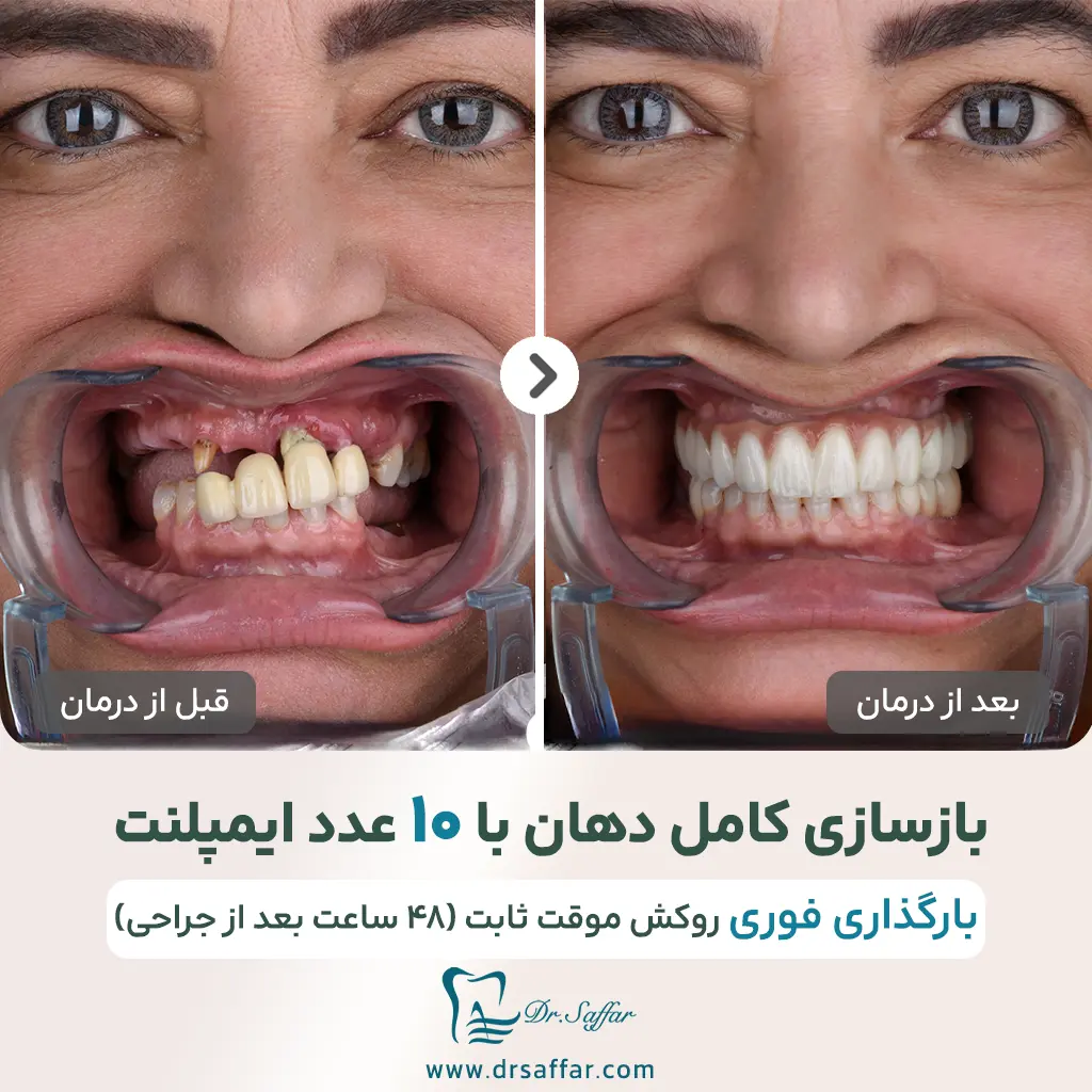 بازسازی کامل دهان با بارگذاری فوری ایمپلنت