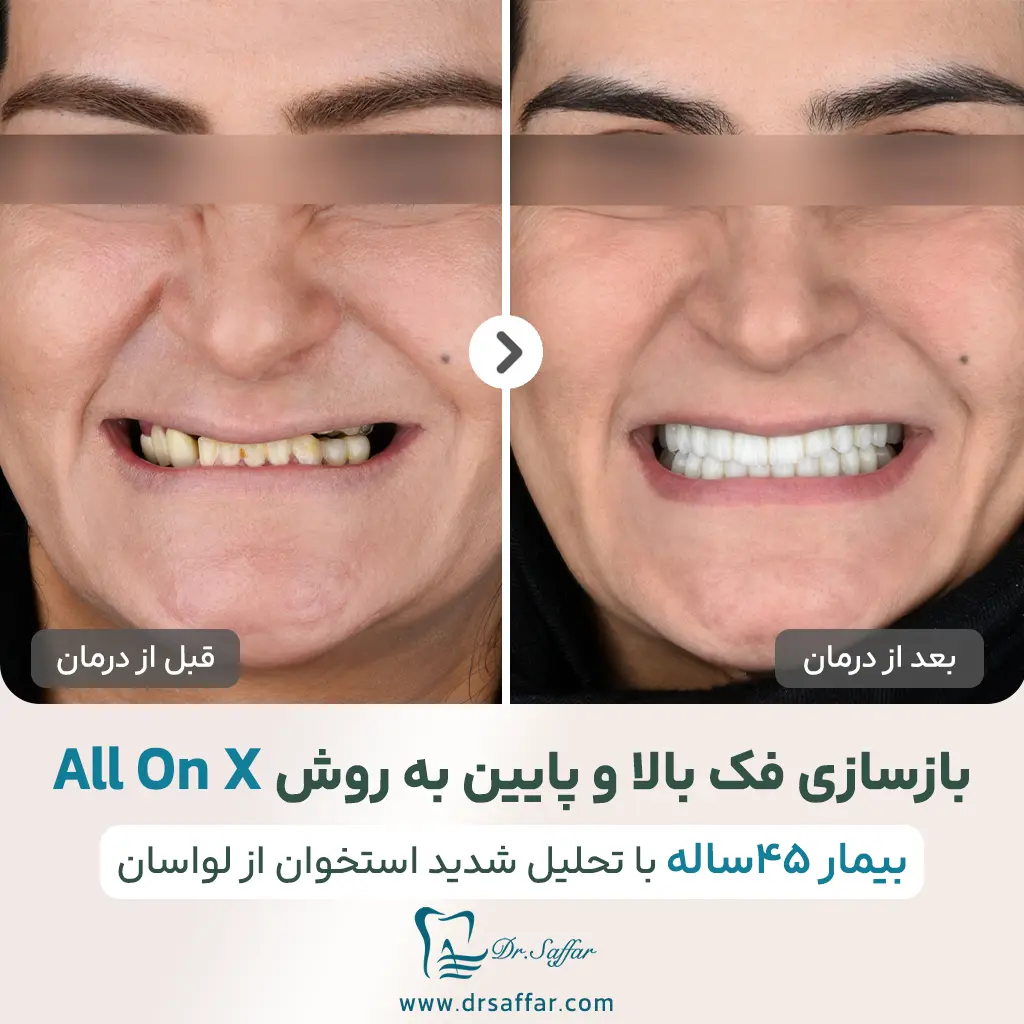 بازسازی کامل دو فک با ایمپلنت به روش All-on-X در مطب دکتر علی صفار
