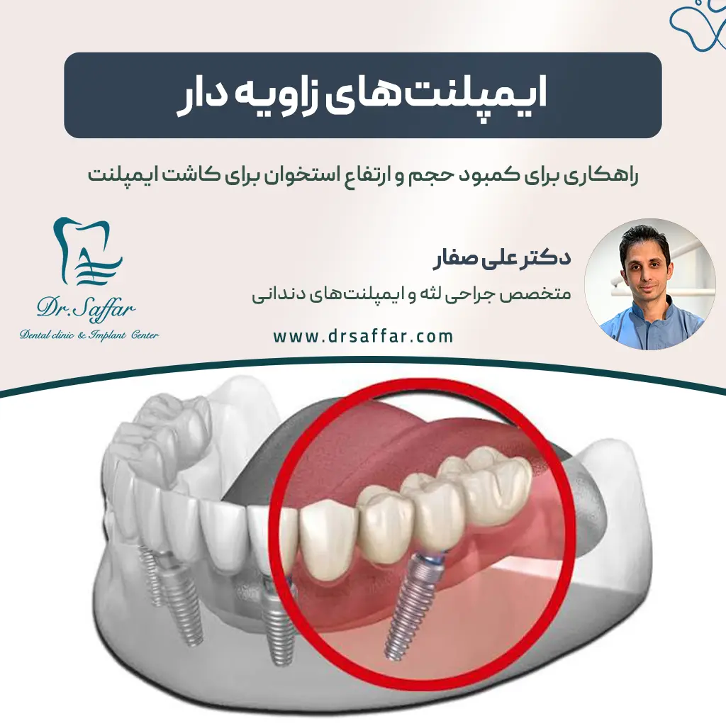 ایمپلنت زاویه دار