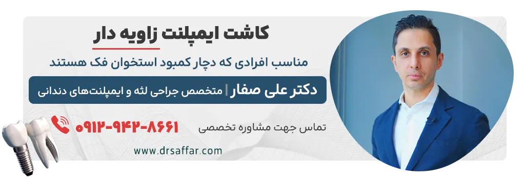 مشاوره تخصصی کاشت ایمپلنت زاویه دار
