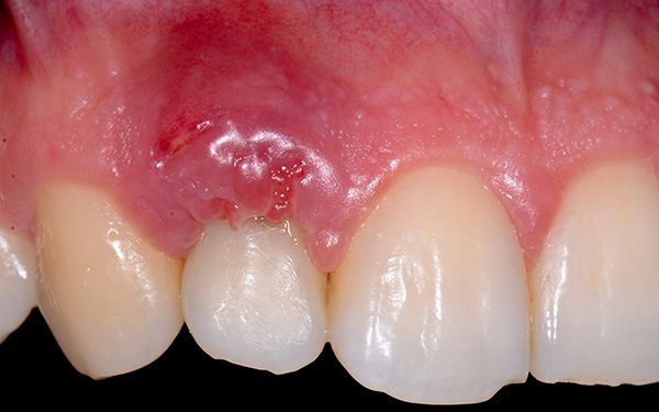 علائم شکست و پس زدن ایمپلنت دندان | کلینیک دندانپزشکی و ایمپلنت دکتر علی صفار