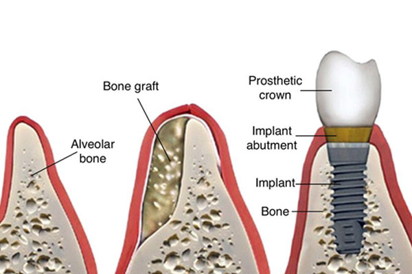 ایمپلنت دندان برای بیماران با پوکی استخوان