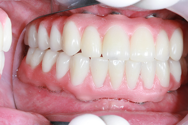 بریج و ایمپلنت دندان