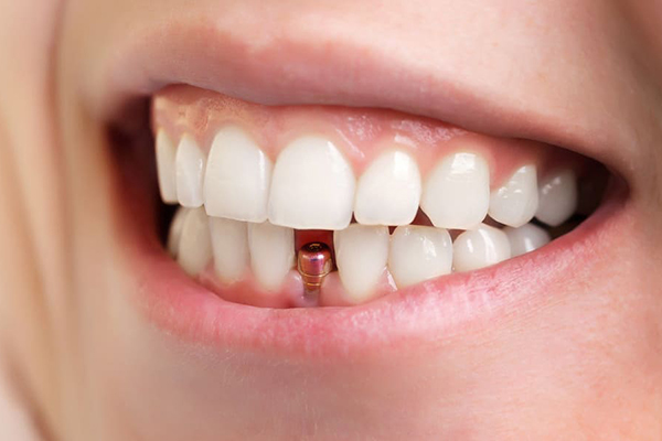 راهنمای جامع ایمپلنت فوری دندان