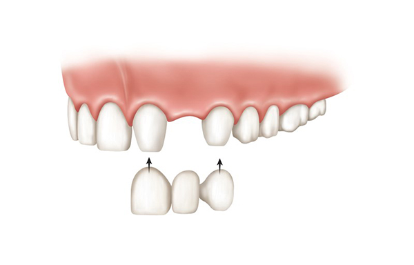 بریج و ایمپلنت دندان