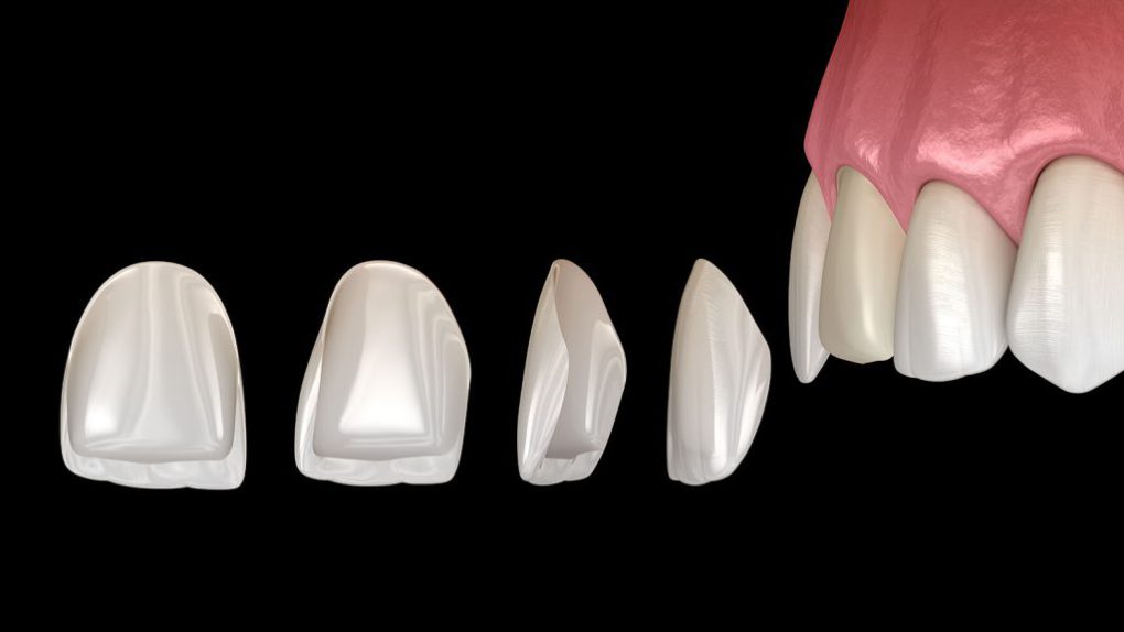 قیمت لمینت دندان و طول مدت درمان