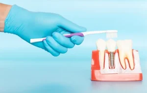 Brushing after implant surgery2