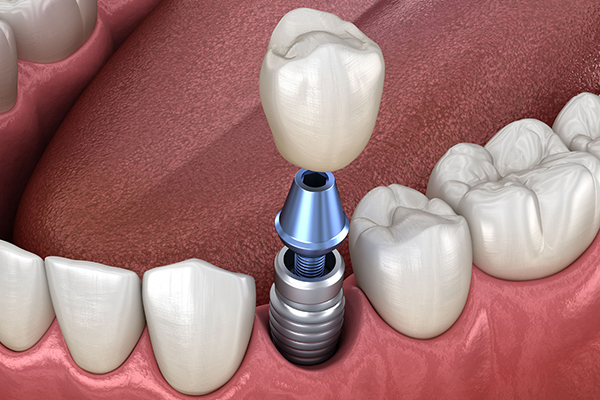 علت باز شدن پیچ ایمپلنت دندان