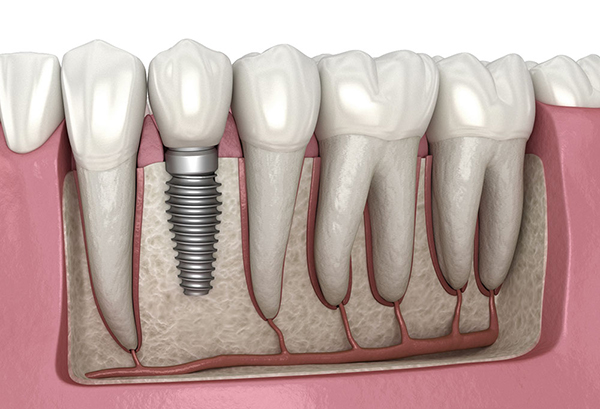 باز شدن پیچ ایمپلنت دندان به دلیل تحلیل استخوان