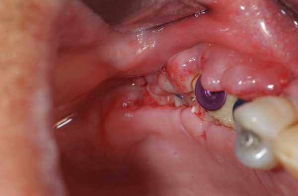 باز شدن پیچ ایمپلنت دندان به دلیل بیماری های لثه