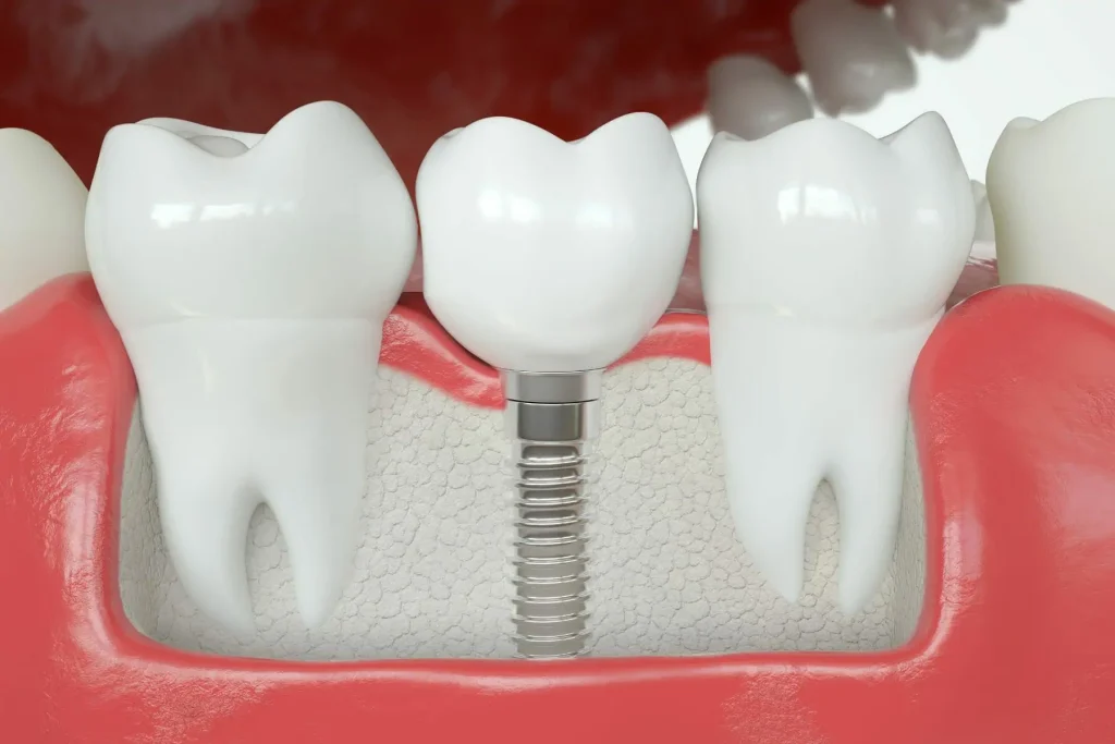 اقدامات پیشگیرانه برای درد ایمپلنت دندان
