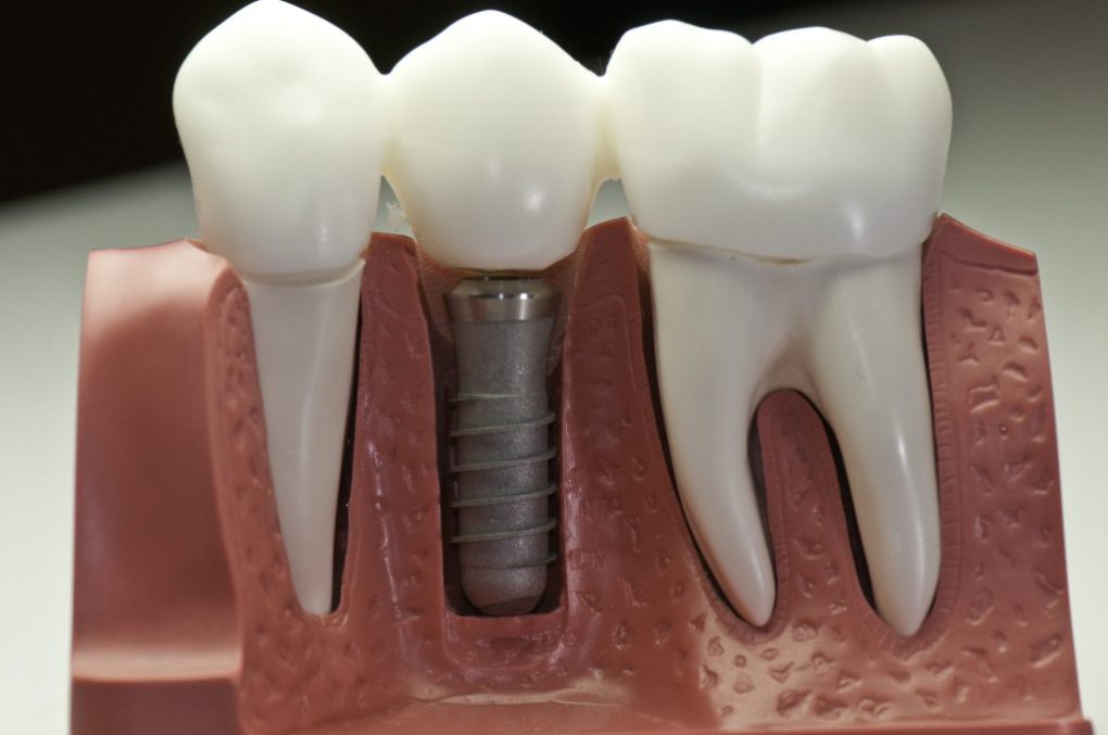 ایمپلنت دندان یک روزه چیست؟