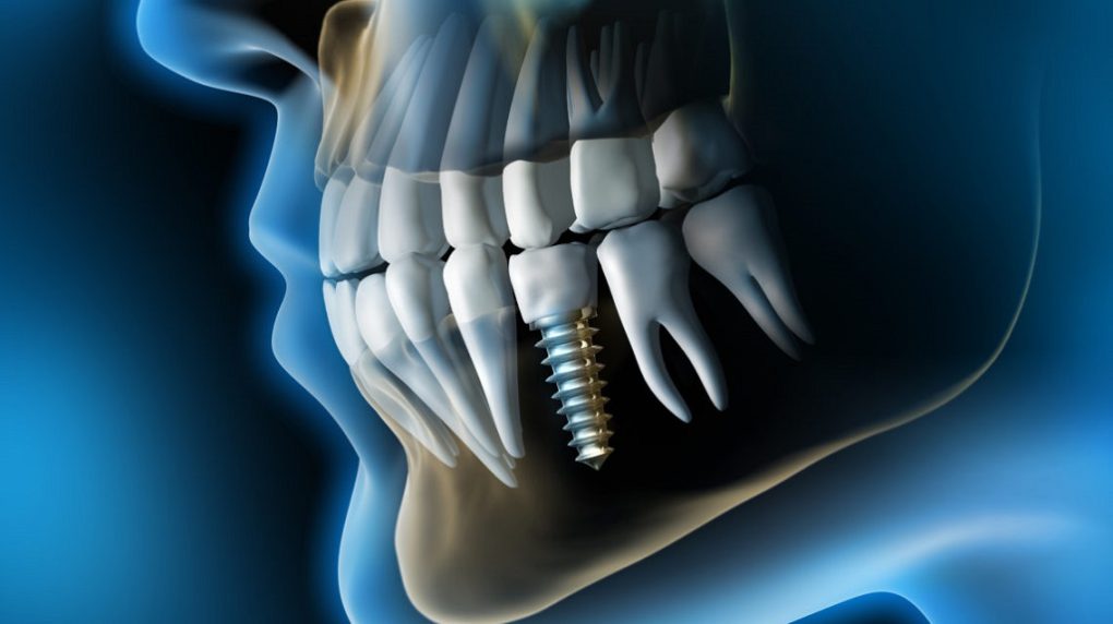 ایمپلنت دندان یک روزه چه تفاوتی دارد؟