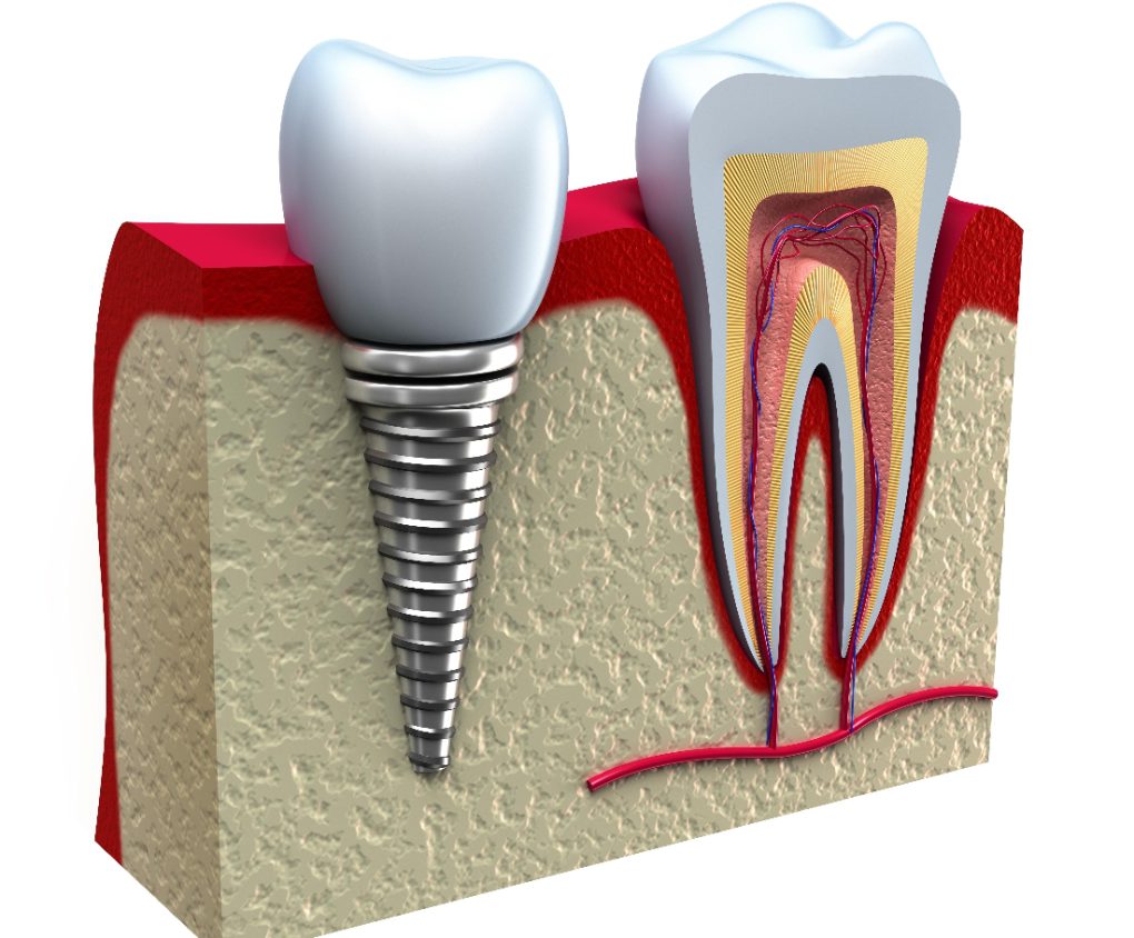 درد ایمپلنت دندان تا چندساعت موجه است؟