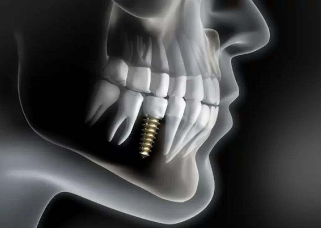Dental implants without surgery