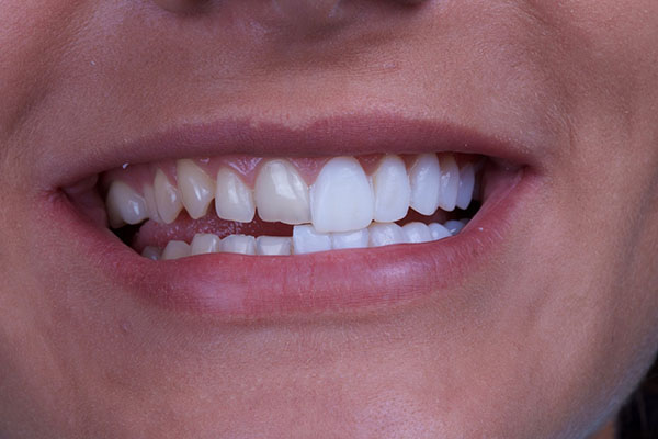 کامپوزیت ونیر دندان