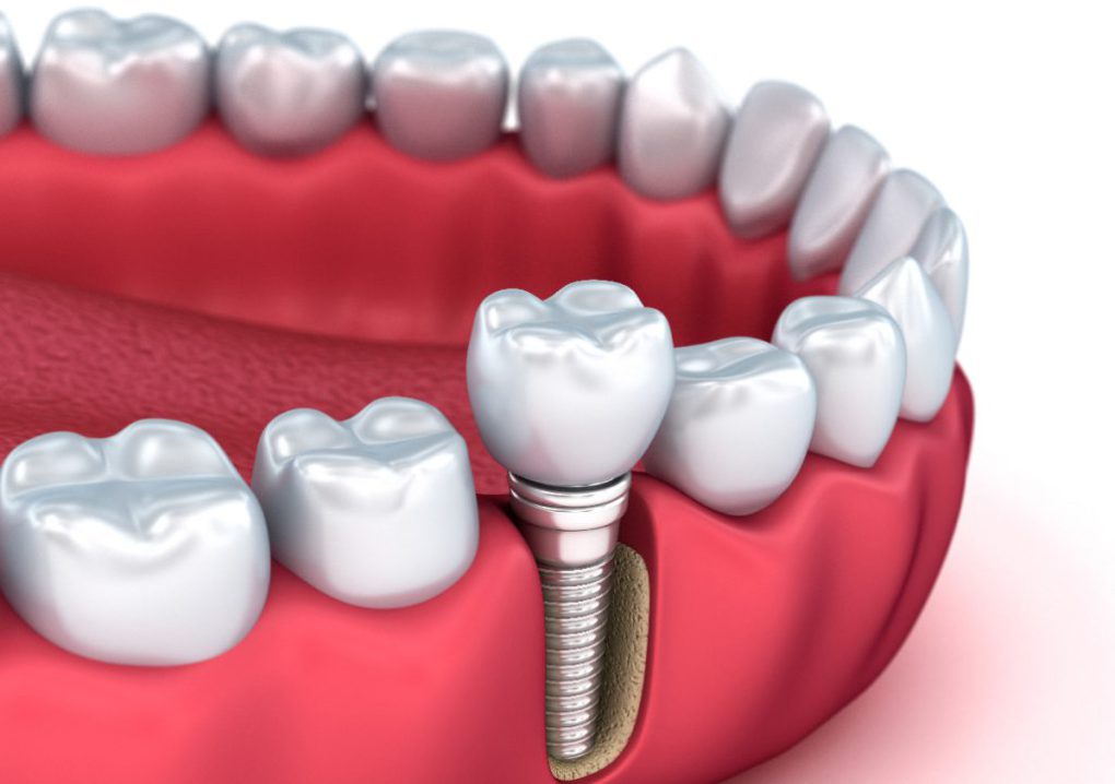علت درد ایمپلنت دندان؟
