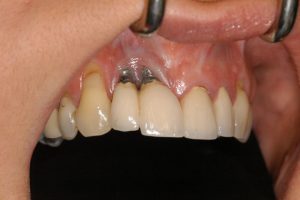 dental implant failure pic