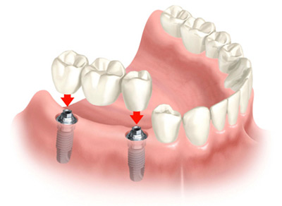 implant6 e12