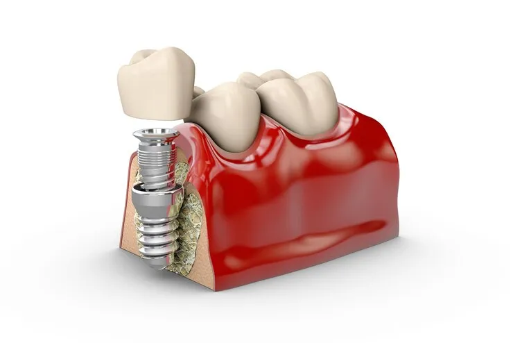 tooth dental imp