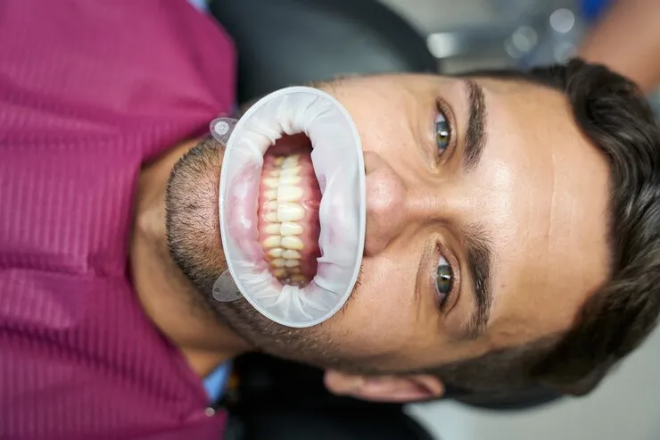 دلایل سفید شدن لثه بعد از جراحی ایمپلنت